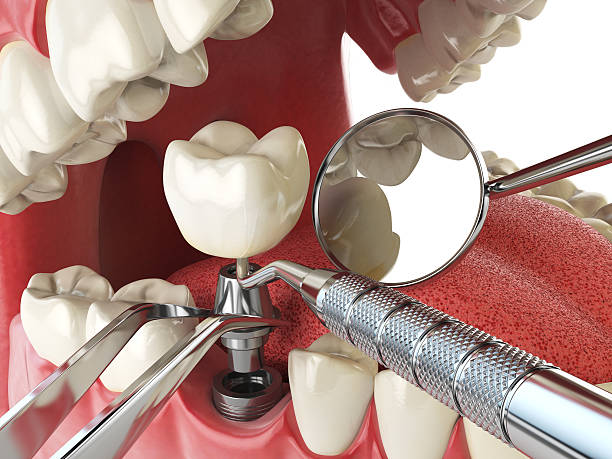 Best Emergency Dental Care for Broken or Chipped Teeth in Mshall, AR